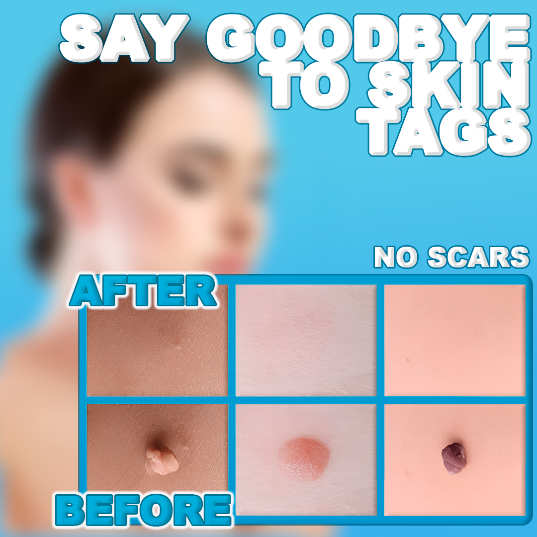 Skin Tag Remover Pen - Painless, Fast-Acting Treatment for Skin Tags, Moles, and Warts at Home