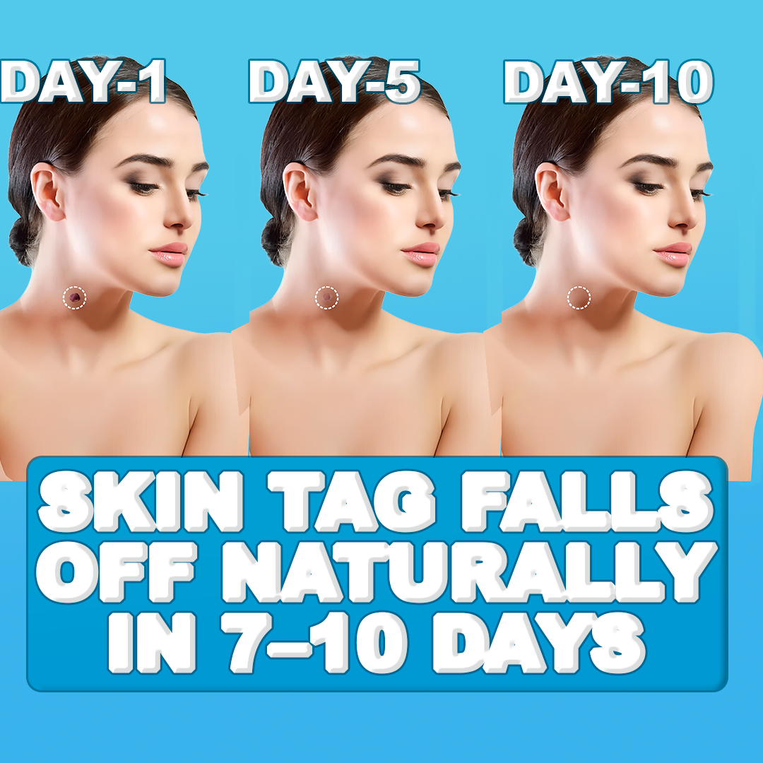 Skin Tag Remover Pen - Painless, Fast-Acting Treatment for Skin Tags, Moles, and Warts at Home