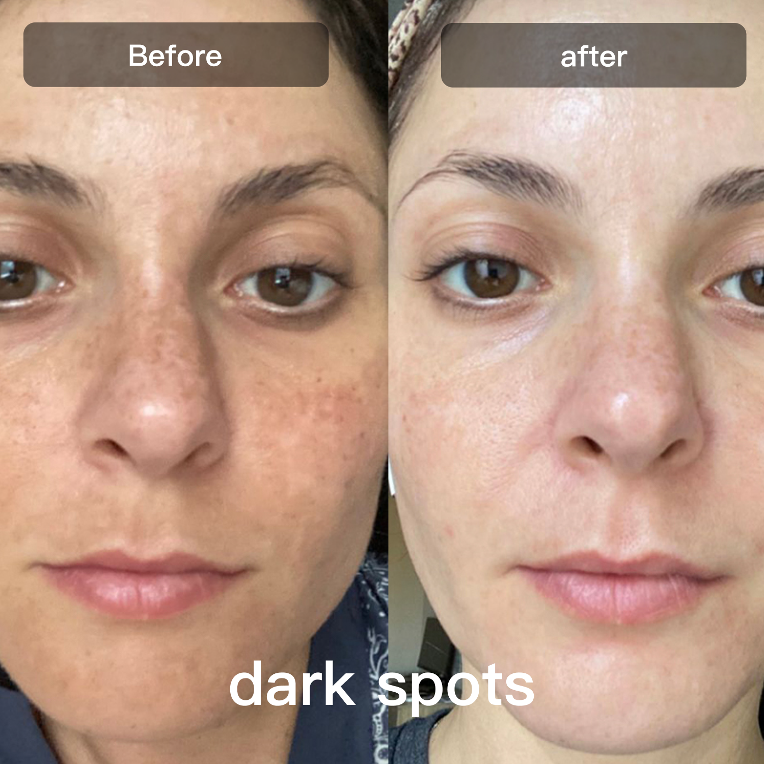 LED Light Therapy Device | 7-in-1 Color Treatment for Face & Body, Reduces Fine Lines, Acne, Inflammation & Pigmentation